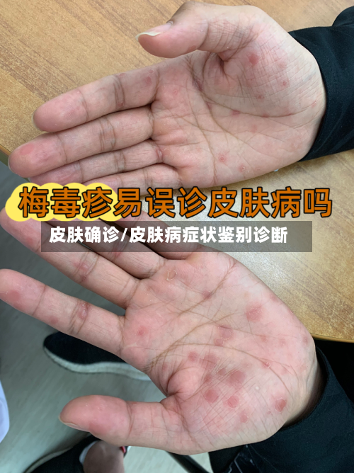皮肤确诊/皮肤病症状鉴别诊断