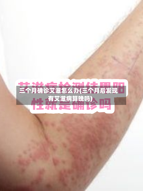 三个月确诊艾滋怎么办(三个月后发现有艾滋病算晚吗)-第3张图片