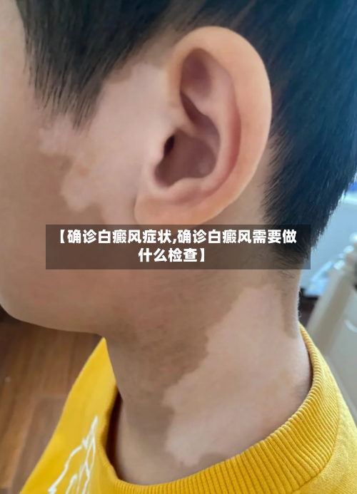 【确诊白癜风症状,确诊白癜风需要做什么检查】