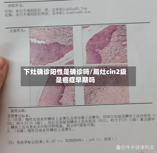 下灶确诊阳性是确诊吗/局灶cin2级是癌症早期吗