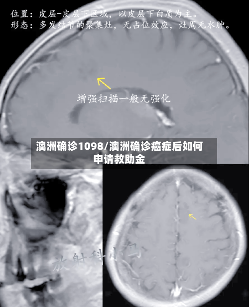澳洲确诊1098/澳洲确诊癌症后如何申请救助金