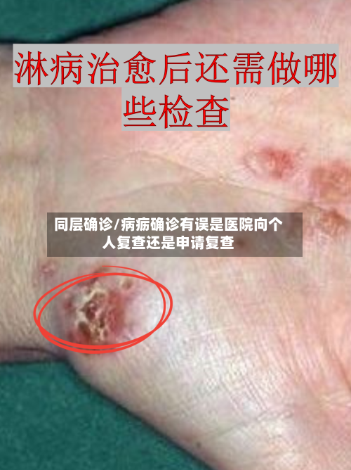 同层确诊/病疬确诊有误是医院向个人复查还是申请复查