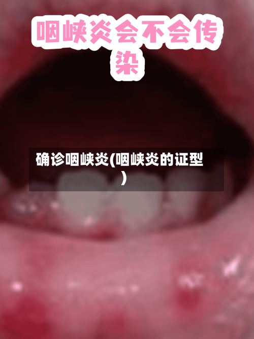 确诊咽峡炎(咽峡炎的证型)-第3张图片