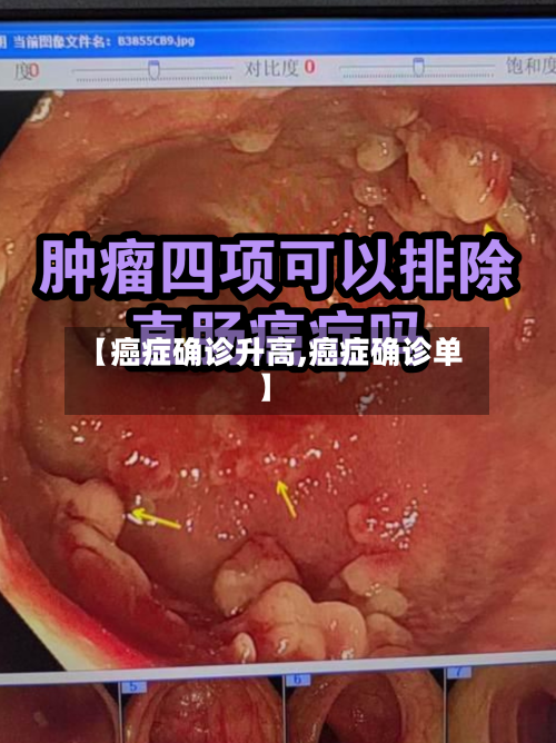 【癌症确诊升高,癌症确诊单】