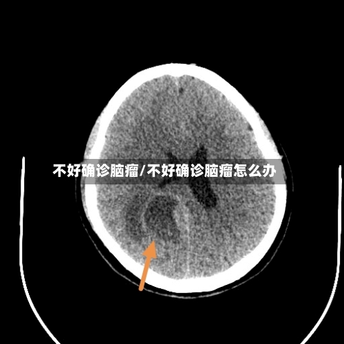 不好确诊脑瘤/不好确诊脑瘤怎么办