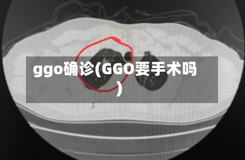 ggo确诊(GGO要手术吗)-第1张图片