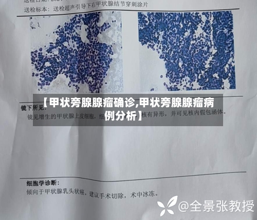 【甲状旁腺腺瘤确诊,甲状旁腺腺瘤病例分析】